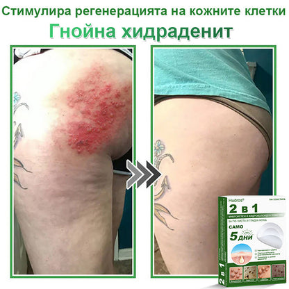 𝐇𝐮𝐝𝐫𝐨𝐬® 📌 𝟐-в-𝟏 хидроколоидни пластири с микроигли | Специално създадени за премахване на изпъкнали бенки, акне, плоски брадавици и кожни образувания | Опаковка от 𝟏𝟒𝟒 броя🌾🌾