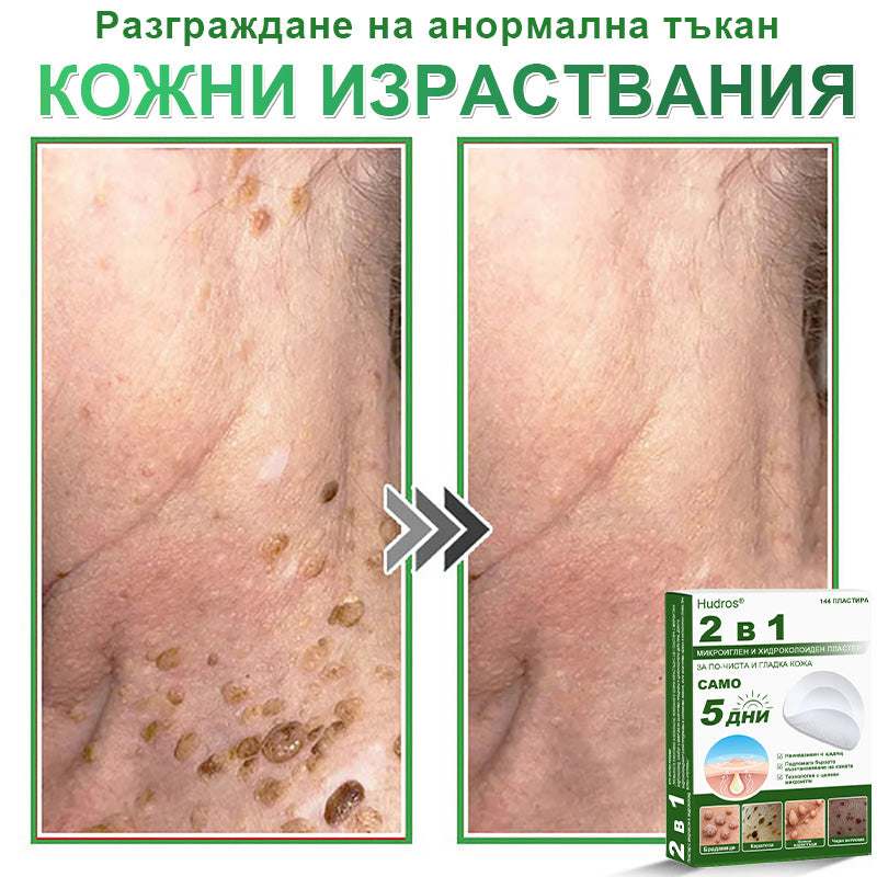 𝐇𝐮𝐝𝐫𝐨𝐬® 📌 𝟐-в-𝟏 хидроколоидни пластири с микроигли | Специално създадени за премахване на изпъкнали бенки, акне, плоски брадавици и кожни образувания | Опаковка от 𝟏𝟒𝟒 броя🌾🌾