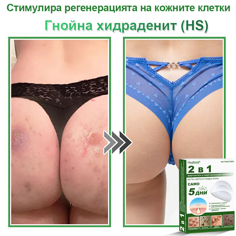𝐇𝐮𝐝𝐫𝐨𝐬® 📌 𝟐-в-𝟏 хидроколоидни пластири с микроигли | Специално създадени за премахване на изпъкнали бенки, акне, плоски брадавици и кожни образувания | Опаковка от 𝟏𝟒𝟒 броя🌾🌾