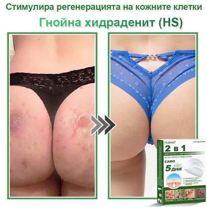 𝐇𝐮𝐝𝐫𝐨𝐬® 📌 𝟐-в-𝟏 хидроколоидни пластири с микроигли | Специално създадени за премахване на изпъкнали бенки, акне, плоски брадавици и кожни образувания | Опаковка от 𝟏𝟒𝟒 броя🌾🌾