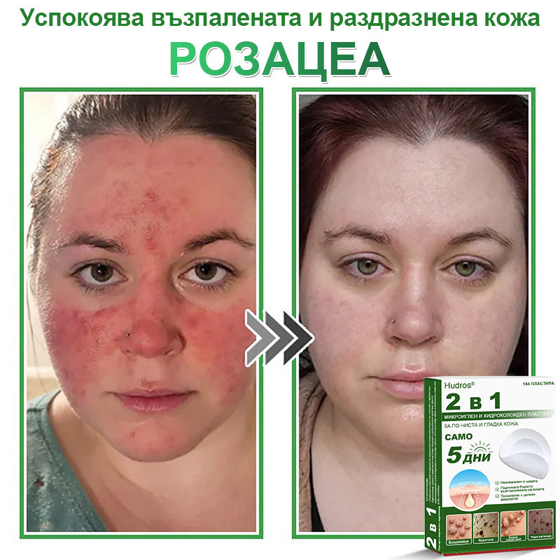 𝐇𝐮𝐝𝐫𝐨𝐬® 📌 𝟐-в-𝟏 хидроколоидни пластири с микроигли | Специално създадени за премахване на изпъкнали бенки, акне, плоски брадавици и кожни образувания | Опаковка от 𝟏𝟒𝟒 броя🌾🌾