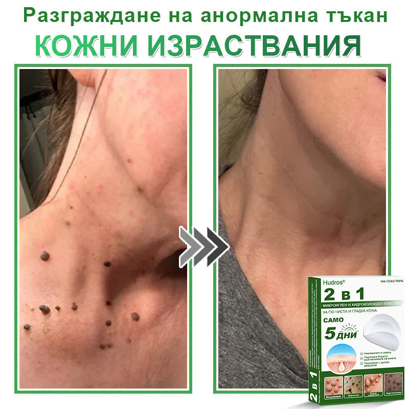 𝐇𝐮𝐝𝐫𝐨𝐬® 📌 𝟐-в-𝟏 хидроколоидни пластири с микроигли | Специално създадени за премахване на изпъкнали бенки, акне, плоски брадавици и кожни образувания | Опаковка от 𝟏𝟒𝟒 броя🌾🌾