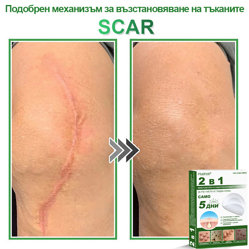 𝐇𝐮𝐝𝐫𝐨𝐬® 📌 𝟐-в-𝟏 хидроколоидни пластири с микроигли | Специално създадени за премахване на изпъкнали бенки, акне, плоски брадавици и кожни образувания | Опаковка от 𝟏𝟒𝟒 броя🌾🌾