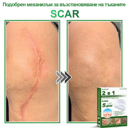 𝐇𝐮𝐝𝐫𝐨𝐬® 📌 𝟐-в-𝟏 хидроколоидни пластири с микроигли | Специално създадени за премахване на изпъкнали бенки, акне, плоски брадавици и кожни образувания | Опаковка от 𝟏𝟒𝟒 броя🌾🌾