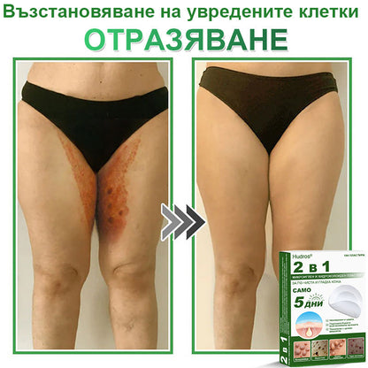 𝐇𝐮𝐝𝐫𝐨𝐬® 📌 𝟐-в-𝟏 хидроколоидни пластири с микроигли | Специално създадени за премахване на изпъкнали бенки, акне, плоски брадавици и кожни образувания | Опаковка от 𝟏𝟒𝟒 броя🌾🌾